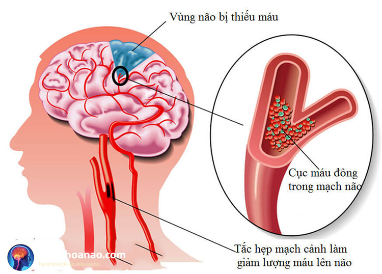 Rối loạn tiền đình và thiếu máu não khác nhau như thế nào? 2