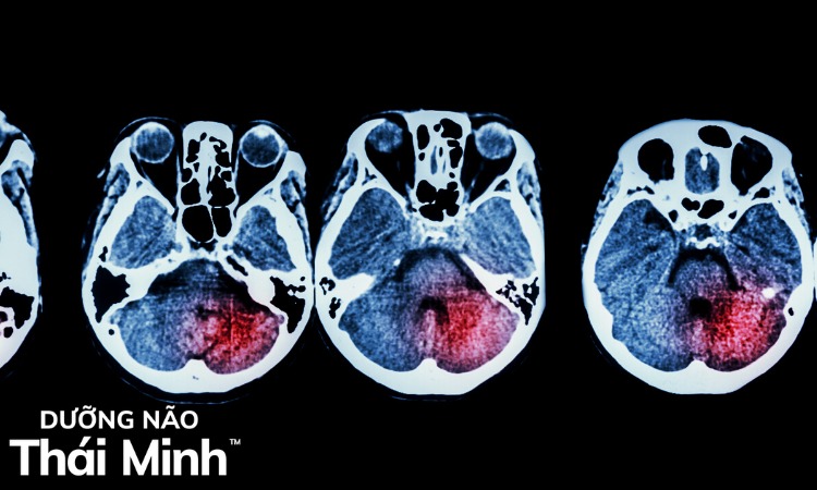 2. Triệu chứng và chẩn đoán thiếu máu não 1