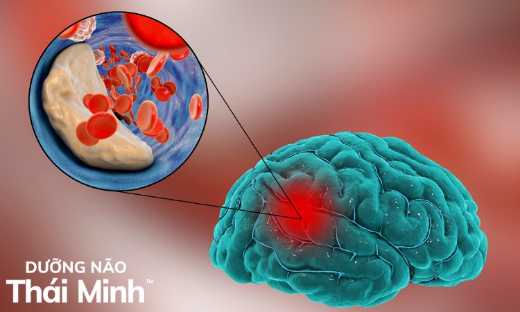 3. Thiếu máu não gây đau đầu có nguy hiểm không? 1
