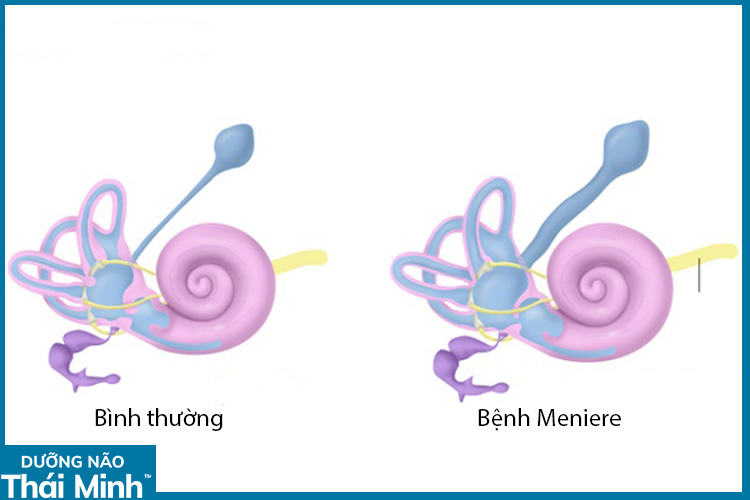 1.2. Ứ nước mê nhĩ 1 1.2. Ứ nước mê nhĩ 1