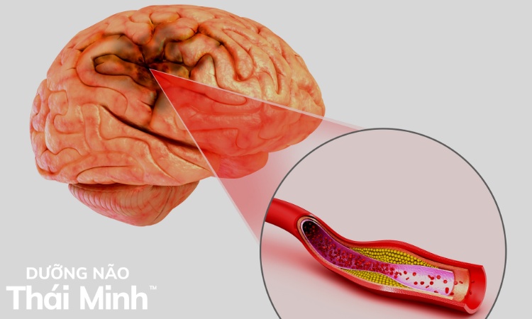 3.2. Xơ vữa động mạch 1
