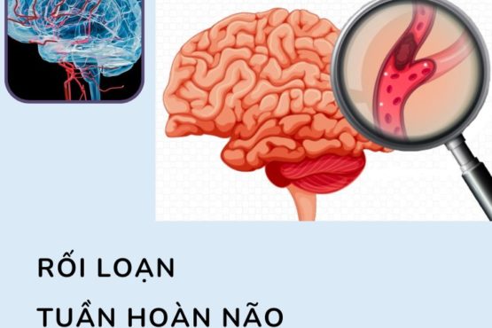 Rối loạn tuần hoàn não: Bệnh thường gặp những chớ chủ quan Rối loạn tuần hoàn não: Bệnh thường gặp những chớ chủ quan