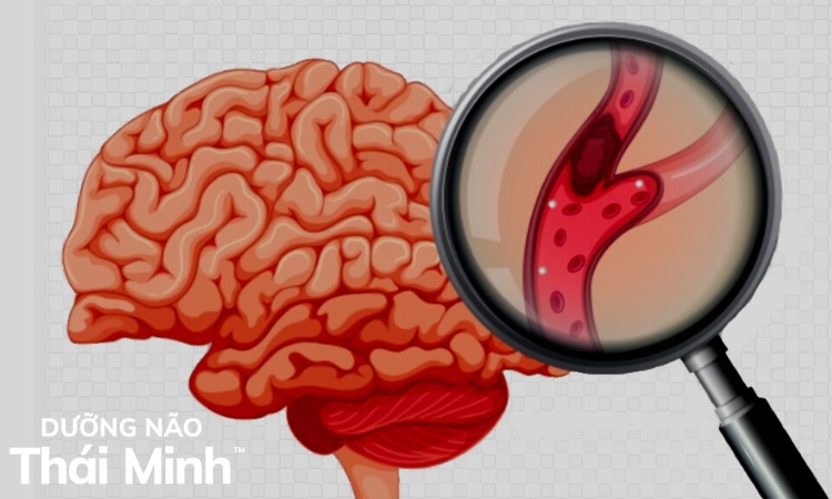 2. Bệnh thiếu máu não ảnh hưởng tới sức khỏe như thế nào? 1
