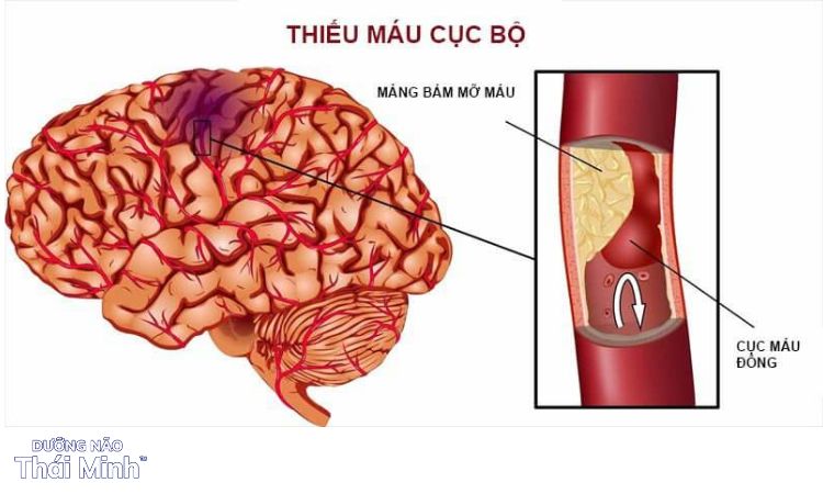 1. Thiếu máu não cục bộ là gì? 1 1. Thiếu máu não cục bộ là gì? 1